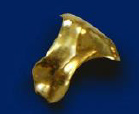 歯の詰め物ゴールドインレー