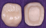 奥歯の被せ物ジルコニア