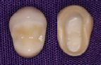 奥歯の被せ物ジルコニアセラミック